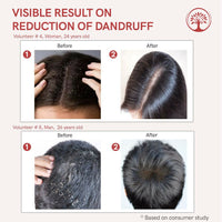 Thumbnail for Ivory Natural Dandruff Hair Serum For Nourishing Dry Scalp