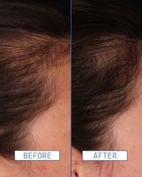 Thumbnail for Aavrani Hair Density Boosting Treatment (Serum)
