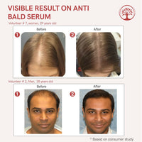 Thumbnail for Ivory Natural Bald Serum For Baldness, Hair Thinning And Hair Fall